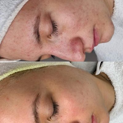 skinbar-kozmetika-elektrokozmetika-alakformalas-dioda-lezeres-kezelesek-dabas-carbon-peeling-03