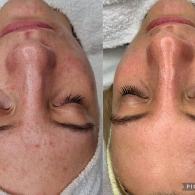skinbar-kozmetika-elektrokozmetika-alakformalas-dioda-lezeres-kezelesek-dabas-carbon-peeling-04