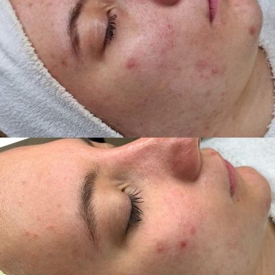 skinbar-kozmetika-elektrokozmetika-alakformalas-dioda-lezeres-kezelesek-dabas-carbon-peeling-05