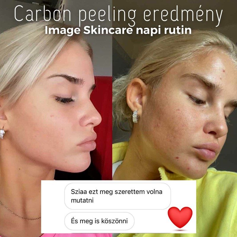 skinbar-kozmetika-elektrokozmetika-alakformalas-dioda-lezeres-kezelesek-dabas-carbon-peeling-01