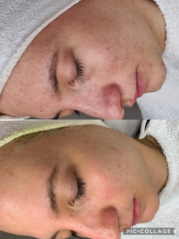 skinbar-kozmetika-elektrokozmetika-alakformalas-dioda-lezeres-kezelesek-dabas-carbon-peeling-03