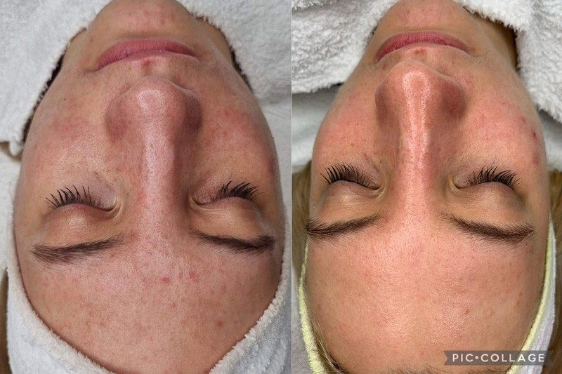 skinbar-kozmetika-elektrokozmetika-alakformalas-dioda-lezeres-kezelesek-dabas-carbon-peeling-04