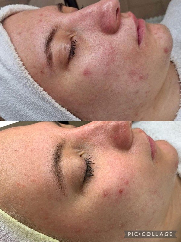 skinbar-kozmetika-elektrokozmetika-alakformalas-dioda-lezeres-kezelesek-dabas-carbon-peeling-05