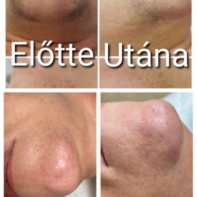 skinbar-kozmetika-elektrokozmetika-alakformalas-dioda-lezeres-kezelesek-dabas-dioda-lezeres-szortelenites-03
