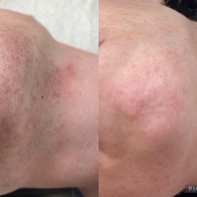 skinbar-kozmetika-elektrokozmetika-alakformalas-dioda-lezeres-kezelesek-dabas-dioda-lezeres-szortelenites-04