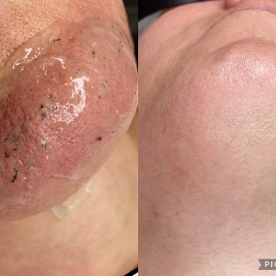 skinbar-kozmetika-elektrokozmetika-alakformalas-dioda-lezeres-kezelesek-dabas-dioda-lezeres-szortelenites-05