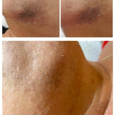 skinbar-kozmetika-elektrokozmetika-alakformalas-dioda-lezeres-kezelesek-dabas-dioda-lezeres-szortelenites-06