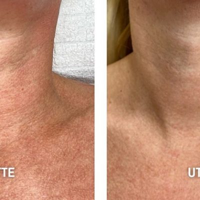 skinbar-kozmetika-elektrokozmetika-alakformalas-dioda-lezeres-kezelesek-dabas-hifu-kezeles-01