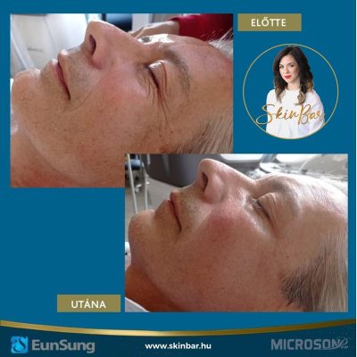 skinbar-kozmetika-elektrokozmetika-alakformalas-dioda-lezeres-kezelesek-dabas-hifu-kezeles-02