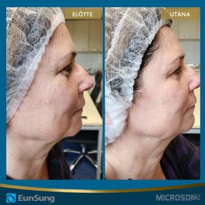 skinbar-kozmetika-elektrokozmetika-alakformalas-dioda-lezeres-kezelesek-dabas-hifu-kezeles-04