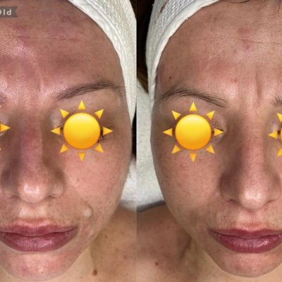skinbar-kozmetika-elektrokozmetika-alakformalas-dioda-lezeres-kezelesek-dabas-hifu-kezeles-08