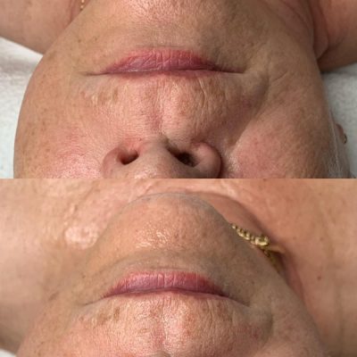 skinbar-kozmetika-elektrokozmetika-alakformalas-dioda-lezeres-kezelesek-dabas-hifu-kezeles-12