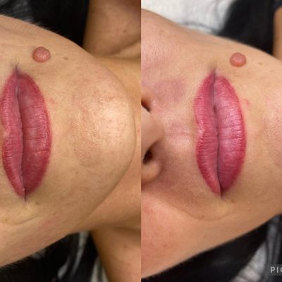 skinbar-kozmetika-elektrokozmetika-alakformalas-dioda-lezeres-kezelesek-dabas-hifu-kezeles-13