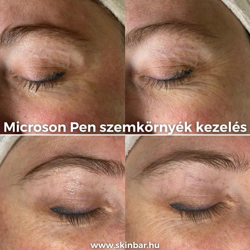 skinbar-kozmetika-elektrokozmetika-alakformalas-dioda-lezeres-kezelesek-dabas-hifu-kezeles-07