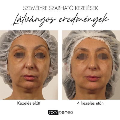 skinbar-kozmetika-elektrokozmetika-alakformalas-dioda-lezeres-kezelesek-dabas-oxygeneo-02