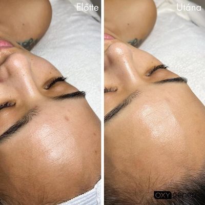 skinbar-kozmetika-elektrokozmetika-alakformalas-dioda-lezeres-kezelesek-dabas-oxygeneo-03