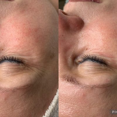 skinbar-kozmetika-elektrokozmetika-alakformalas-dioda-lezeres-kezelesek-dabas-oxygeneo-05