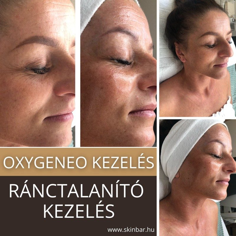 skinbar-kozmetika-elektrokozmetika-alakformalas-dioda-lezeres-kezelesek-dabas-oxygeneo-01